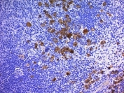 IHC: Formalin-fixed, paraffin-embedded human Hodgkin's lymphoma stained with CD30 antibody (Ber-H2 + CD30/412).