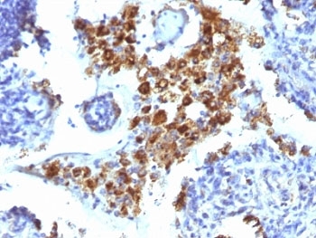IHC: Formalin-fixed, paraffin-embedded human lung Adenocarcinoma stained with Napsin-A ant