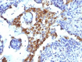 IHC: Formalin-fixed, paraffin-embedded human lung adenocarcinoma stained with Napsin-A antibody (NAPSA/1239).~