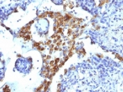 IHC: Formalin-fixed, paraffin-embedded human lung adenocarcinoma stained with Napsin-A antibody (NAPSA/1239).