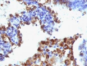 IHC: Formalin-fixed, paraffin-embedded human lung adenocarcinoma stained with Napsin-A antibody (NAPSA/1238 + NAPSA/1239).~