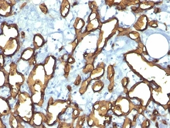 IHC: Formalin-fixed, paraffin-embedded human angiosarcoma stained with CD34 antibody (HPCA1/763)~