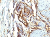 IHC: Formalin-fixed, paraffin-embedded human colon carcinoma stained with CD34 antibody (QBEnd/10 + HPCA1/763)