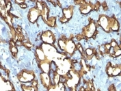 IHC: Formalin-fixed, paraffin-embedded human angiosarcoma stained with CD34 antibody (QBEnd/10 + HPCA1/763)