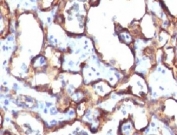 IHC: Formalin-fixed, paraffin-embedded human angiosarcoma stained with anti-CD34 antibody (HPCA1/1171)