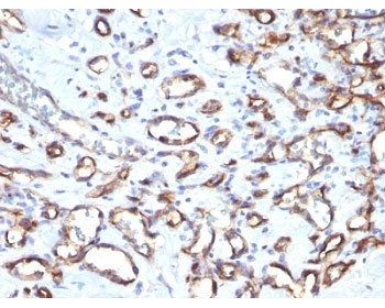 IHC: Formalin-fixed, paraffin-embedded human angiosarcoma stained with CD34 antibody (SPM610)~