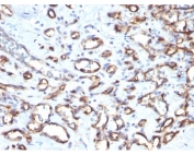 IHC: Formalin-fixed, paraffin-embedded human angiosarcoma stained with CD34 antibody (SPM610)