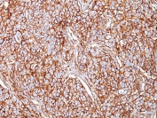 IHC: Formalin-fixed, paraffin-embedded human breast carcinoma stained with CD44 antibody (clone SPM521).