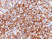 IHC: Formalin-fixed, paraffin-embedded human breast carcinoma stained with CD44 antibody (clone HCAM/918).