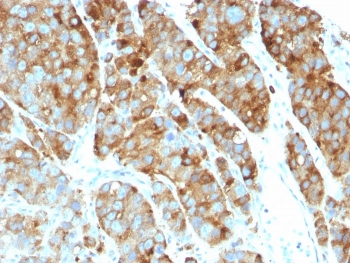 IHC: Formalin-fixed, paraffin-embedded human prostate carcinoma stained with CD63 / LAMP-3 antibody (LAMP3/968).~