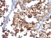 IHC: Formalin-fixed, paraffin-embedded human melanoma stained with CD63 / LAMP-3 antibody (LAMP3/968).