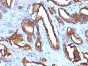 IHC: Formalin-fixed, paraffin-embedded human prostate carcinoma stained with CD63 antibody (NKI/C3 + LAMP3/968)