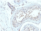 IHC: Formalin-fixed, paraffin-embedded human testicular carcinoma stained with CD63 antibody (NKI/C3 + LAMP3/968)