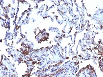 IHC: Formalin-fixed, paraffin-embedded human melanoma metastasized to lung stained with CD63 antibody (NKI/C3 + LAMP3/968)~