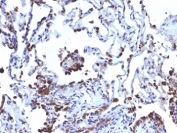 IHC: Formalin-fixed, paraffin-embedded human melanoma metastasized to lung stained with CD63 antibody (NKI/C3 + LAMP3/968)