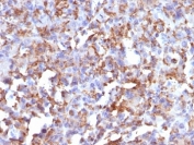 IHC: Formalin-fixed, paraffin-embedded human histiocytoma stained with CD68 antibody (LAMP4/824).