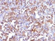 IHC: Formalin-fixed, paraffin-embedded human histiocytoma stained with CD68 antibody (LAMP4/824).