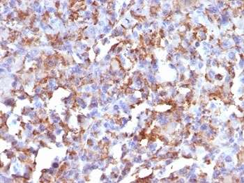 IHC: Formalin-fixed, paraffin-embedded human histiocytoma stained with CD68 antibody (LAMP4/824).