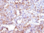 IHC: Formalin-fixed, paraffin-embedded human Histiocytoma stained with CD68 antibody (CD68/G2).