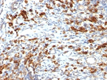 IHC: Formalin-fixed, paraffin-embedded human lymphoma stained with CD79a antibody (clone IGA/764).~