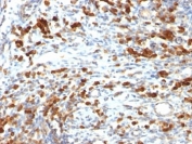 IHC: Formalin-fixed, paraffin-embedded human lymphoma stained with CD79a antibody (clone IGA/764).