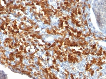 IHC staining of FFPE human lymphoma with CD79a antibody (clone IGA/515). HIER: formalin-fixed tissues requires boiling tissue sections in pH 9 10mM Tris with 1mM EDTA, for 10-20 min followed by cooling at RT for 20 min.~