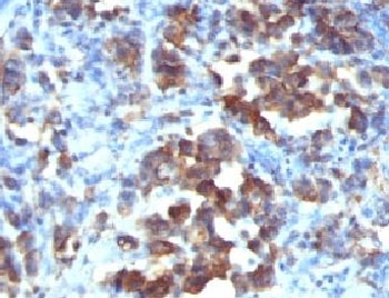 IHC: Formalin-fixed, paraffin-embedded human gastric carcinoma stained with Cdc20 antibody (CDC20/1102)~