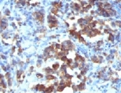 IHC: Formalin-fixed, paraffin-embedded human gastric carcinoma stained with Cdc20 antibody (CDC20/1102)