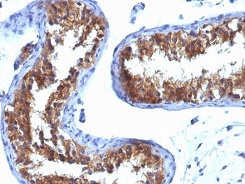 IHC analysis of formalin-fixed, paraffin-embedded human testicular carcinoma stained with Major Vault Protein antibody (clone 1032).~