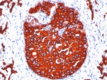 IHC: Formalin-fixed, paraffin-embedded human breast carcinoma stained with pan Cytokeratin antibody cocktail (KRTL/1077 + KRTH/1076).~