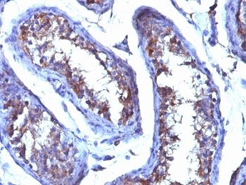 IHC testing of FFPE human testicular carcinoma with Testosterone antibody (clone 4E1G2). Required HIER: boil tissue sections in 10mM citrate buffer, pH 6, for 10-20 min followed by cooling at RT for 20 min.~