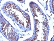 IHC testing of FFPE human testicular carcinoma with Testosterone antibody (clone 4E1G2). Required HIER: boil tissue sections in 10mM citrate buffer, pH 6, for 10-20 min followed by cooling at RT for 20 min.