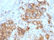 IHC: Formalin-fixed, paraffin-embedded human gastric carcinoma stained with CA19-9 antibody (121SLE).