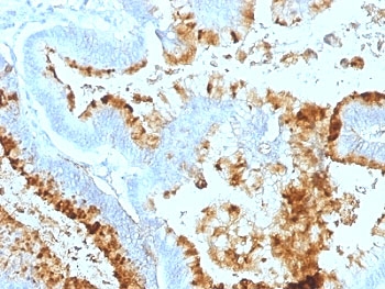 IHC: Formalin-fixed, paraffin-embedded human colon carcinoma stained with Blood Group Lewis a antibody (clone 7LE).~