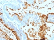 IHC: Formalin-fixed, paraffin-embedded human colon carcinoma stained with Blood Group Lewis a antibody (clone 7LE).