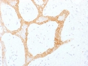 IHC analysis of formalin-fixed, paraffin-embedded human colon carcinoma stained with Cytokeratin 5/8 antibody (clone C-50). Required HIER: digest sections with Trypsin at 1mg/ml, 15 min, at RT.