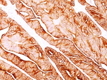 IHC analysis of formalin-fixed, paraffin-embedded human colon carcinoma stained with Cytokeratin 5/8 antibody (clone C-50). Required HIER: digest sections with Trypsin at 1mg/ml, 15 min, at RT.~