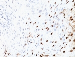 IHC: Formalin-fixed, paraffin-embedded human cervix stained with HPV-16 antibody (SPM405)