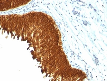 IHC: Formalin-fixed, paraffin-embedded human bladder carcinoma stained with Multi Cytokeratin antibody (KRT/457).~