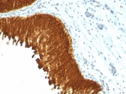 IHC: Formalin-fixed, paraffin-embedded human bladder carcinoma stained with Multi Cytokeratin antibody (KRT/457).