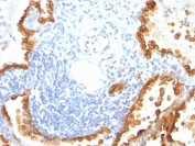 IHC: Formalin-fixed, paraffin-embedded human lung carcinoma stained with Cytokeratin 8/18 antibody (KRT8/803 + KRT18/835).