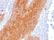 IHC staining of FFPE human squamous cell carcinoma with pan Cytokeratin antibody cocktail (clone Cocktail PAN-CK). HIER: boil tissue sections in pH 9 10mM Tris with 1mM EDTA for 20 min and allow to cool before testing.