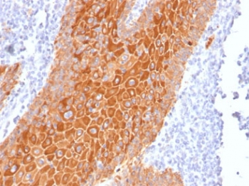 IHC staining of FFPE human squamous cell carcinoma with pan Cytokeratin antibody cocktail (clone Cocktail PAN-CK). HIER: boil tissue sections in pH 9 10mM Tris with 1mM EDTA for 20 min and allow to cool before testing.