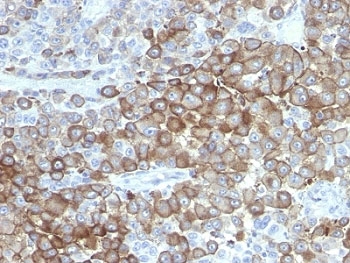 IHC anlaylsis of formalin-fixed, paraffin-embedded human melanoma stained with Melanoma antibody (clone PNL2).~
