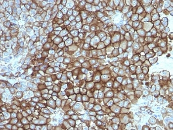 IHC: Formalin-fixed, paraffin-embedded human melanoma stained with Melanoma Associated Antigen antibody (clone KBA.62).~