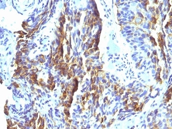 IHC: Formalin-fixed, paraffin-embedded human tongue stained with Melanoma Associated Antigen antibody (clone KBA.62)