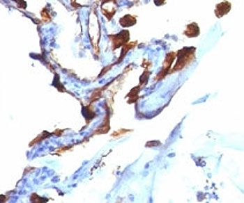 IHC analysis of formalin-fixed, paraffin-embedded human lung carcinoma stained with Cytokeratin 8/18 antibody (clone C-51).~