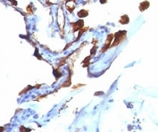 IHC analysis of formalin-fixed, paraffin-embedded human lung carcinoma stained with Cytokeratin 8/18 antibody (clone C-51).