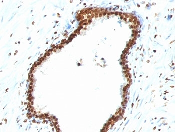 IHC staining of FFPE human colon carcinoma with dsDNA antibody (clone 121-3). HIER: boil tissue sections in pH 9 10mM Tris with 1mM EDTA for 10-20 min and allow to cool before testing.~