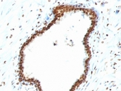 IHC staining of FFPE human colon carcinoma with dsDNA antibody (clone 121-3). HIER: boil tissue sections in pH 9 10mM Tris with 1mM EDTA for 10-20 min and allow to cool before testing.